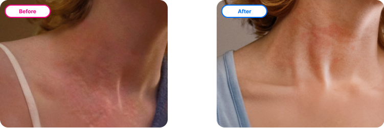 Before and after images of improvements in HSS7 at week 12.